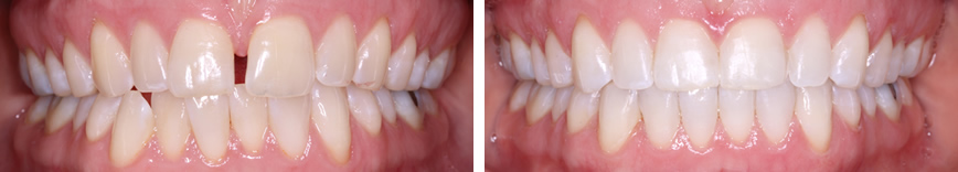 Invisalign